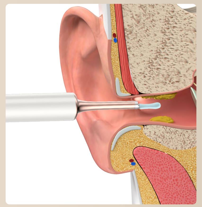 odstraňovač ušního mazu čištění usi usha